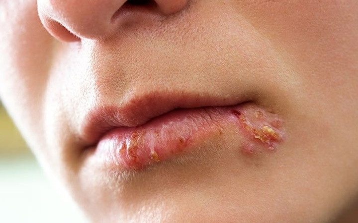 10 căn bệnh của mùa Đông mà ai cũng có thể mắc phải - Hình 7 10 can benh cua mua Dong ma ai cung co the mac phai-Hinh-7