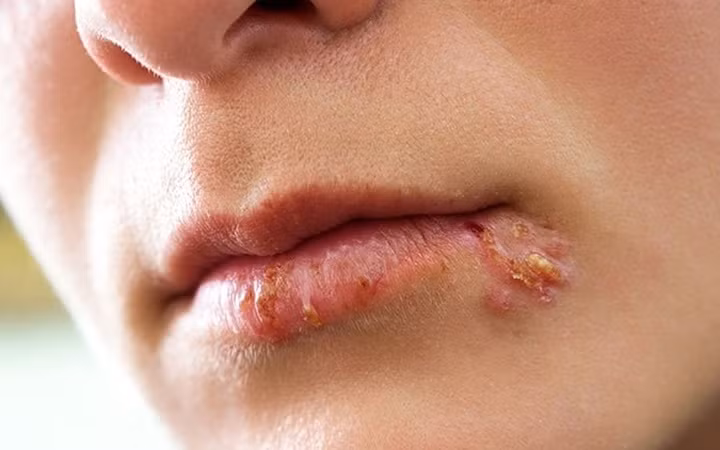 10 can benh cua mua Dong ma ai cung co the mac phai-Hinh-7