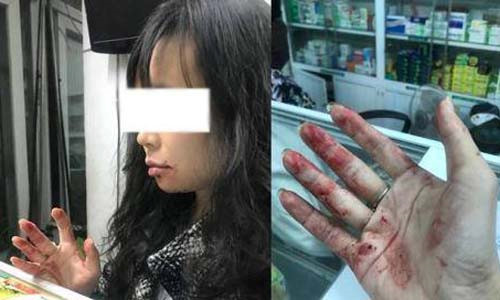 Chị Linh bị tài xế Uber đánh chảy máu mồm.