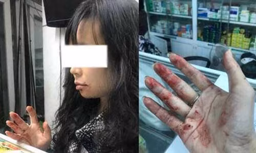 Chị Linh bị tài xế Uber đánh chảy máu mồm.