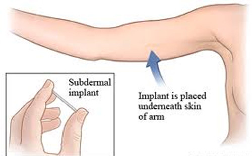 Que cấy tránh thai. Phương pháp này được cho là có hiệu quả tuyệt đối. Que được cấy dưới da tay không thuận của người phụ nữ, phát huy tác dụng sau 24 tiếng và có hiệu quả trong 3 năm. Trong que cấy có nội tiết tố nên trong 3 năm đó, bạn không cần sử dụng đến bất kỳ biện pháp tránh thai nào khác. Nó rất phù hợp với người không có kế hoạch sinh con trong một thời gian dài.