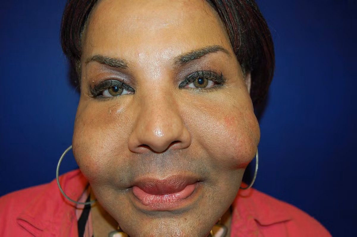 Vị bác sĩ “rởm” Morris bị bắt vào đầu tháng này vì đã bơm hợp chất trên vào một phụ nữ khác. Morris đã đặt ống vào nhiều vùng quanh mông nạn nhân và bơm hợp chất tự chế độc hại vào. Nạn nhân đã kêu đau, nhưng Morris an ủi rằng không sao.