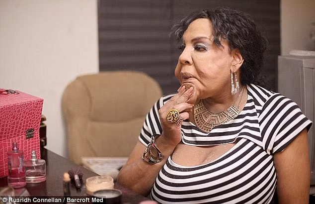 Dù gương mặt bị méo mó nhưng Rajee đã tự tin để trang điểm và chuẩn bị cho buổi hẹn hò ngày Valentine.