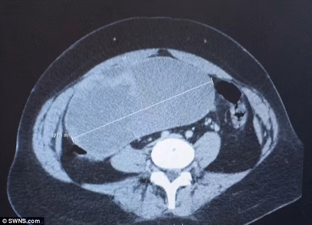 kinh hoang khoi u to nhu qua bong trong tu cung hinh anh