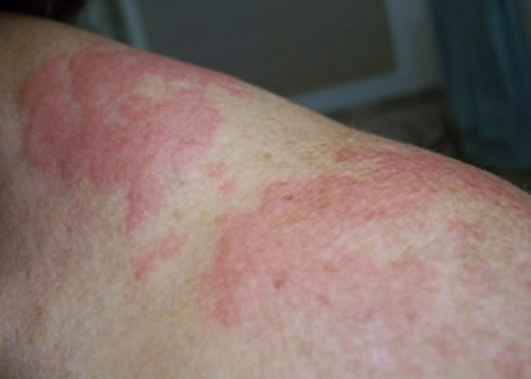 Dị úng khi tròi lạnh, cách nào phòng chóng?