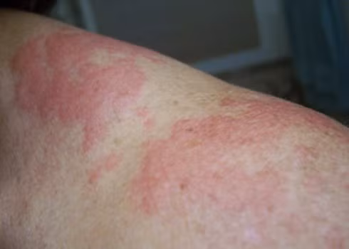 Dị úng khi tròi lạnh, cách nào phòng chóng?