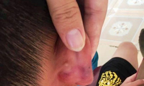 Cháu T. bị bạo hành với nhiều thương tích trên cơ thể.