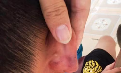 Cháu T. bị bạo hành với nhiều thương tích trên cơ thể.