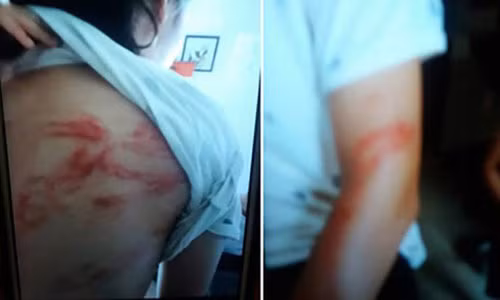 Bức ảnh chụp thương tích trên người cháu N.H.P sau trận đòn của bố do hàng xóm chụp lại.