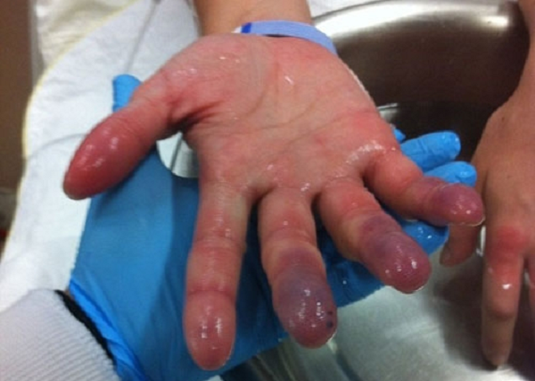 Đá khô có nhiệt độ lên tới -78,5ºC. Khi chạm vào đá khô sẽ gây cảm giác bỏng rát. Cảm giác do bỏng lạnh bởi đá khô còn khó chịu hơn khi bỏng nóng bởi nước sôi rất nhiều. Vì vậy, khi sử dụng cần phải có đồ bảo hộ, các loại găng tay khi tiếp xúc trực tiếp đá khô để tránh bỏng da. Mời các bạn xem video: Phát minh độc đáo cứu người khỏi biển lửa. Nguồn: VTV