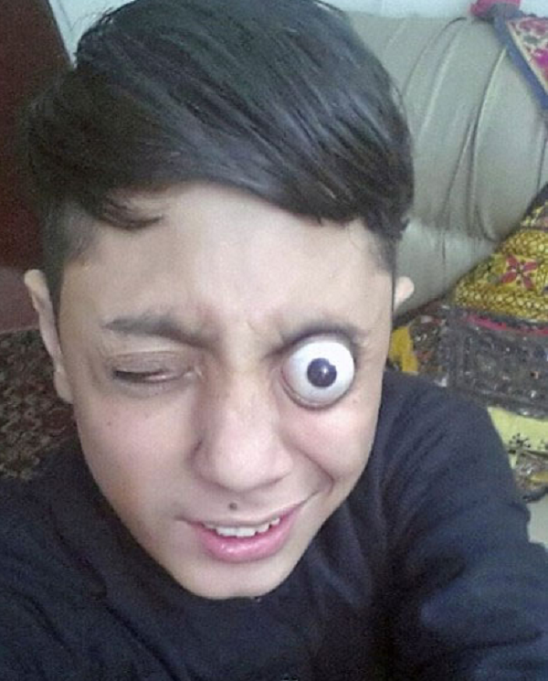 Ahmed Khan có thể kéo nhãn cầu ra ngoài 12 mm so với hốc mắt và khẳng định điều đó không gây hại gì cho bản thân. Không chỉ thế, cậu bé còn có thể giữ nguyên như vậy trong hơn 1 phút đồng hồ, đến lúc cả hai mắt đều trở nên đỏ ngầu.