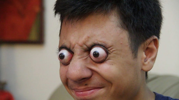 “Một ngày nọ, tôi đã về nhà và xem chương trình hoạt hình nổi tiếng Tom và Jerry. Nhìn thấy đôi mắt của Tom bay ra khỏi hốc mắt sau khi bị Jerry đánh vào lưng, tôi bèn thử với đôi mắt của mình và nhãn cầu thật sự lồi hẳn ra ngoài...