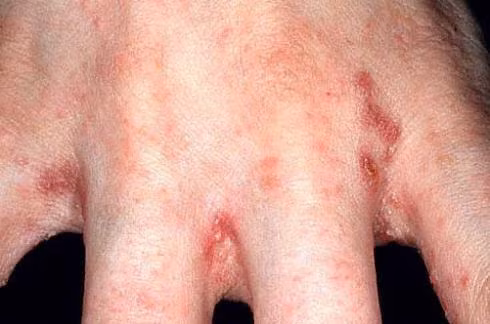 Lấy vỏ thân cây sầu riêng nấu nước tắm có thể chữa được các bệnh ghẻ lở ngoài da. Ảnh: Thực dưỡng.