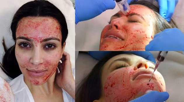 Ngay cả những ngôi sao nổi tiếng thế giới như Kim Kardashian cũng từng dùng mặt nạ máu tươi để làm đẹp da mặt. Ảnh: Dailymail.