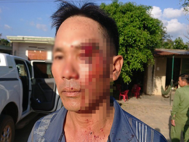Ông Nguyễn Văn Hôm bị thương ở mặt và sống lưng sau.