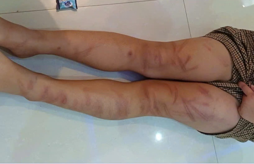 Học sinh mầm non bị bạn đánh: Tạm đình chỉ giáo viên trông lớp Hoc sinh mam non bi ban danh: Tam dinh chi giao vien trong lop