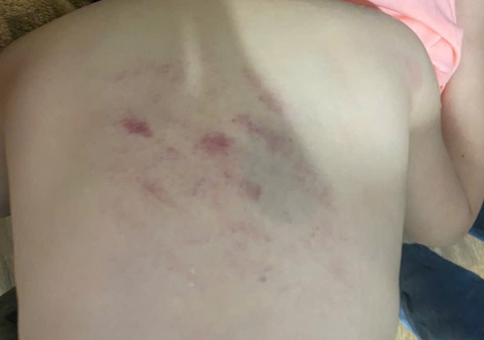 Thanh Hoá: Học sinh lớp 1 bị cô đánh vào lưng gây thâm tím Thanh Hoa: Hoc sinh lop 1 bi co danh vao lung gay tham tim