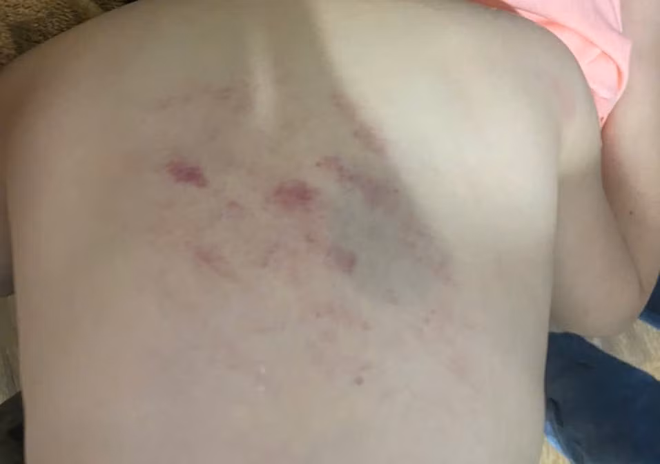 Thanh Hoá: Học sinh lớp 1 bị cô đánh vào lưng gây thâm tím Thanh Hoa: Hoc sinh lop 1 bi co danh vao lung gay tham tim