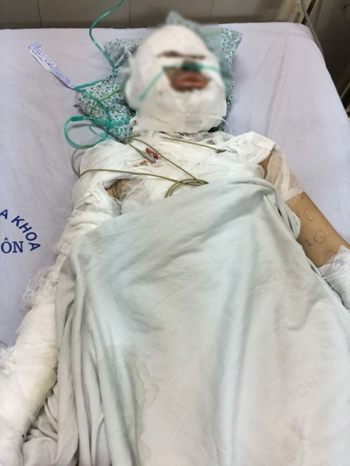 Chị H. bị thiêu sống dẫn đến bỏng toàn thân, hiện đang được điều trị tại Bệnh viện Xanh Pôn (Hà Nội).