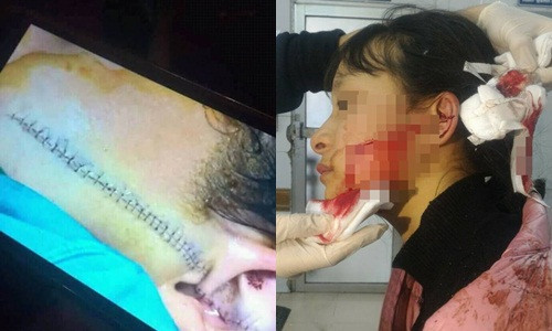 Khuôn mặt của nữ sinh P.L bị rạch dài 14cm, sâu 0,5cm.