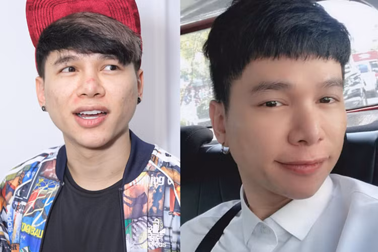 Tuy nhiên, sau khi phẫu thuật thẩm mỹ, mũi và cằm của Hoàng Tôn bị sưng, không hài hòa với gương mặt nên anh dao kéo một lần nữa. Ảnh: Dân Việt