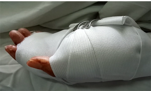 Bàn tay nạn nhân đã được ghép thành công. Nguồn ảnh CAND.