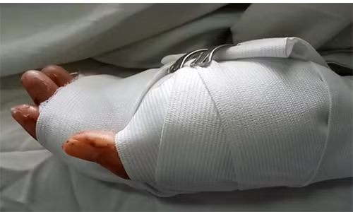 Bàn tay nạn nhân đã được ghép thành công. Nguồn ảnh CAND.