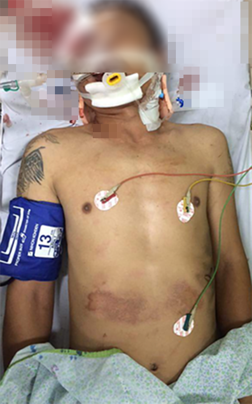 Nan nhan bi o to keo le hang tram met gio the nao?