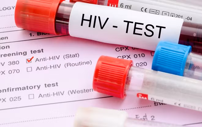 HIV/AIDS: HIV ảnh hưởng đến khả năng sản xuất hormone của cơ thể, bao gồm testosterone và estrogen. Điều này dẫn đến các vấn đề về tình dục và ham muốn giảm. Các loại thuốc tầm soát virus HIV cũng có thể cản trở đời sống tình dục, gây rối loạn cương dương ở nam giới. Ảnh: Health24.
