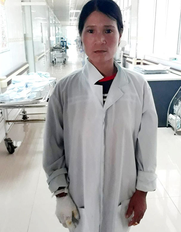 Mẹ của Linh lấy cả cánh tay kéo cháu lên khỏi hố vôi cũng bị bỏng. Ảnh: GĐCC