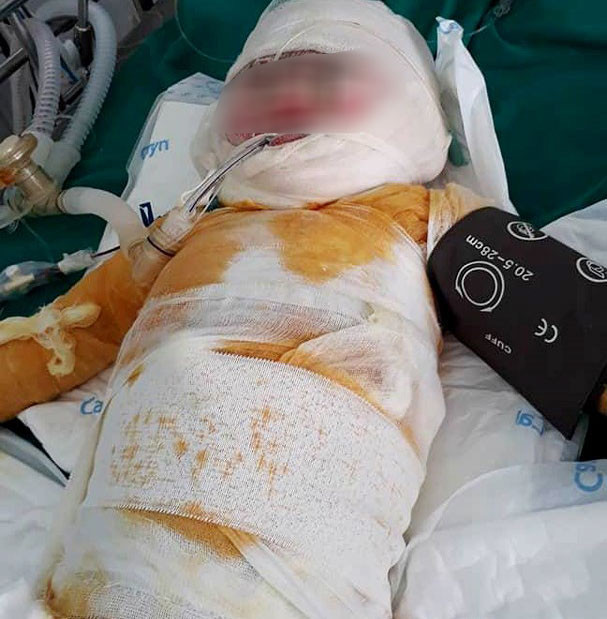 Bé Bùi Nhật Linh đang rất nguy kịch được điều trị tại Viện Bỏng Quốc gia. Ảnh: GĐCC.