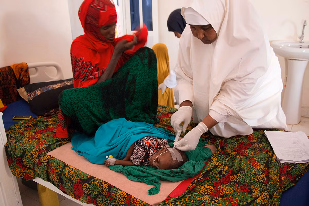 Một em nhỏ bị suy dinh dưỡng được điều trị tại bệnh viện Garowe ở Puntland.