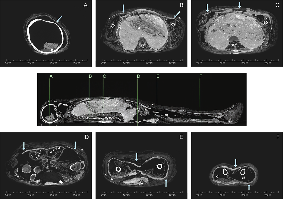 Sau khi qua đời, người phụ nữ được ướp xác và quấn nhiều lớp vải. Thi hài này đầu gối trái và cẳng chân bị phá hủy có thể là do những tên trộm mộ gây ra. Vì vậy, con cháu của người chết đã bọc lại xác ướp và trát bùn xung quanh.