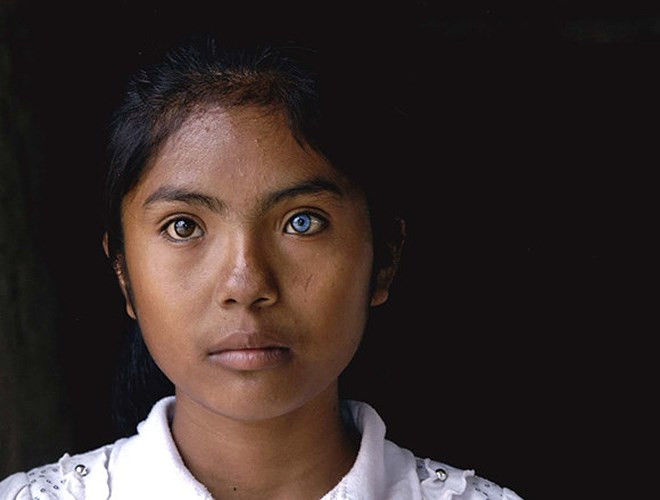 Được biết bố của Sa Pa có hai mắt màu xanh, còn mẹ em mắt đen bình thường. Riêng người anh trai của em có hai mắt màu xanh. Sa Pa cho biết, thị lực của em và mọi người trong nhà hoàn toàn bình thường không có gì khác mặc dù người ngoài nhìn vào có cảm giác như con mắt màu xanh có thể có vấn đề