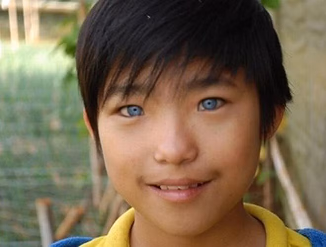 Cậu bé Nguyễn Văn Hào ở Đà Lạt sinh năm 1999 cũng sở hữu đôi mắt màu xanh nước biển khiến nhiều người ngỡ ngàng. Đôi mắt lạ khiến bé Hào gặp không ít phiền toái