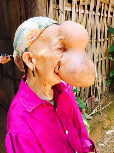 Dù mang khối u đáng sợ, nhưng trường hợp như bà Chài không phải hiếm. Đã từng có rất nhiều người khổ sở vì phải mang những khối u khổng lồ trên mặt như người phụ nữ này.