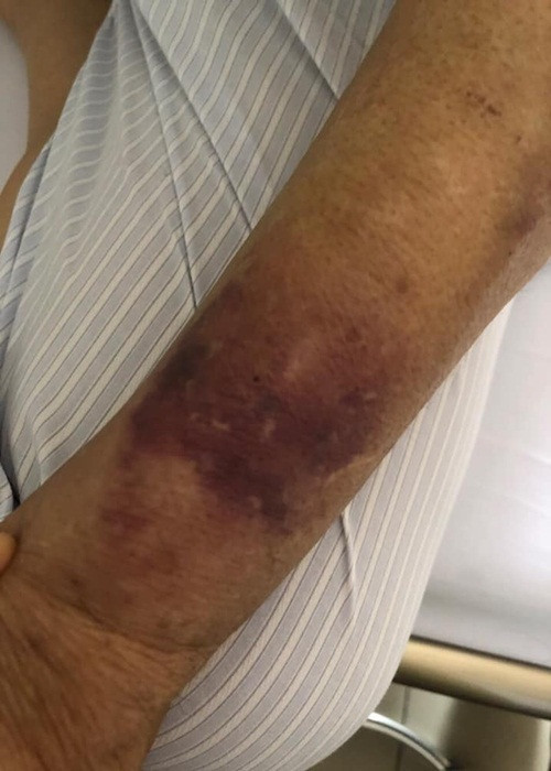 Đi kèm chia sẻ hình ảnh tay sưng, bầm tím, phải lấy ven chân, Giang Còi hài hước viết: "Lấy ven chân không phải tay hết máu. Lấy ven chân để cháu còn chừa. Đôi tay để nghịch để vày. Để quấn băng dính để mày thua ông".