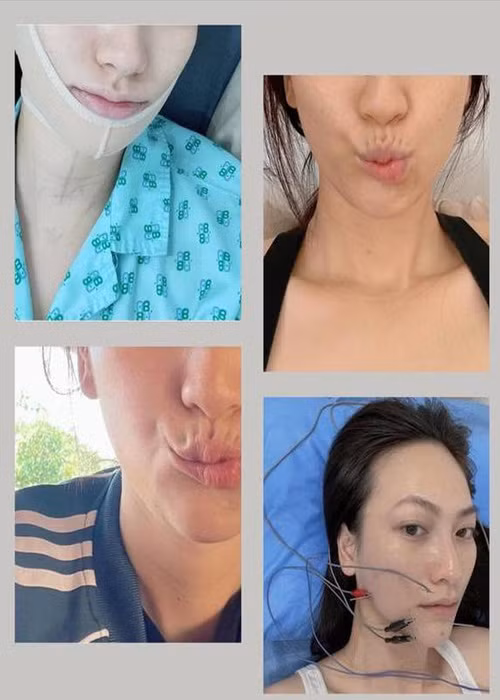  Phương Anh Đào phát hiện mắc bệnh u tuyến giáp vào năm 2020. Tháng 4 vừa qua, cô nhập viện để phẫu thuật. Sau ca mổ, nữ diễn viên bị lệch khung môi mỗi khi vận động.