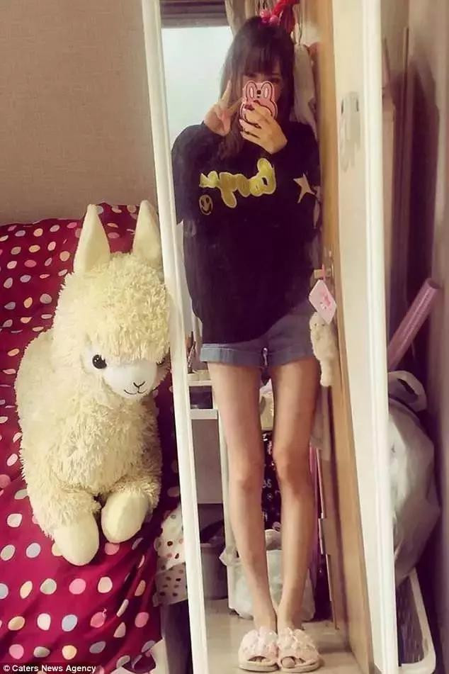 Quá tự ti vì không thể sống như một con búp bê, Venus quyết định đến Hàn Quốc, thực hiện phẫu thuật cắt dạ dày để giảm cân.