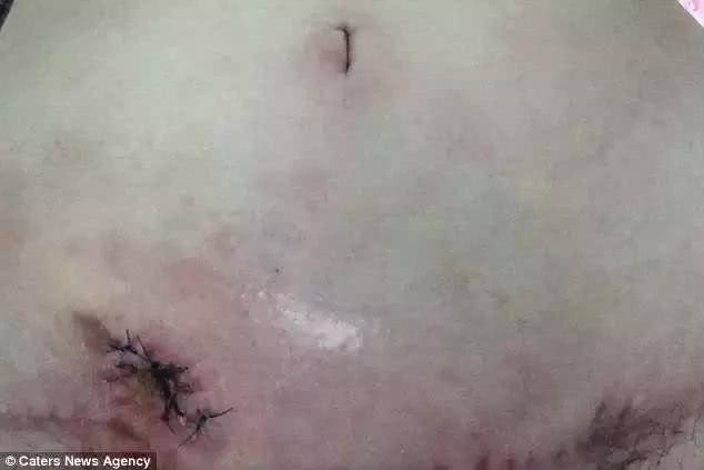 Cho đến một ngày, phần bụng của Venus trướng lên, có dấu hiệu bục vỡ. Cô gái trẻ mới hốt hoảng nói với gia đình và tới bệnh viện để cấp cứu. Khi đến được bệnh viện, Venus đã ở trên bờ vực của cái chết. May mắn thay, nhờ sự cứu chữa tận tâm của các bác sĩ, Venus đã được cứu sống.