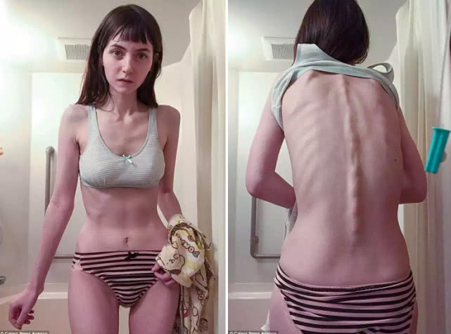 Câu chuyện của Venus như một lời nhắc nhở đến mọi người. Ai cũng có vẻ đẹp riêng, nếu muốn giảm cân cũng không nên quá vội vàng, dùng sai cách như cô gái cắt dạ dày để giảm cân, tránh trường hợp gặp hậu quả nghiêm trọng nhưng cô gái trẻ người Anh.