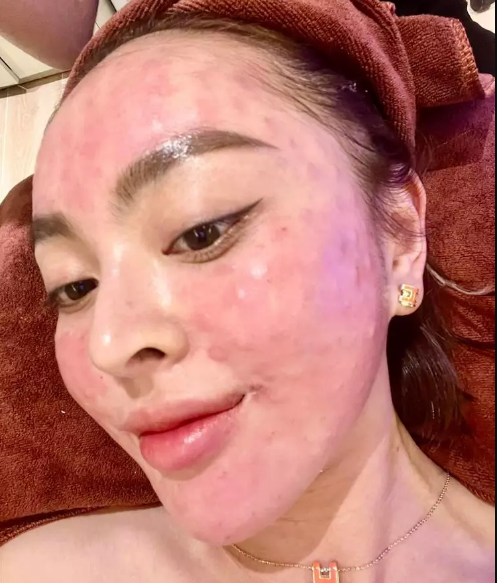 Mới đây, Trang Nemo gây chú ý khi chia sẻ hình ảnh gương mặt đỏ chót, sần sùi,... trông chẳng khác nào bị bỏng nặng, ai nhìn cũng thấy hãi.