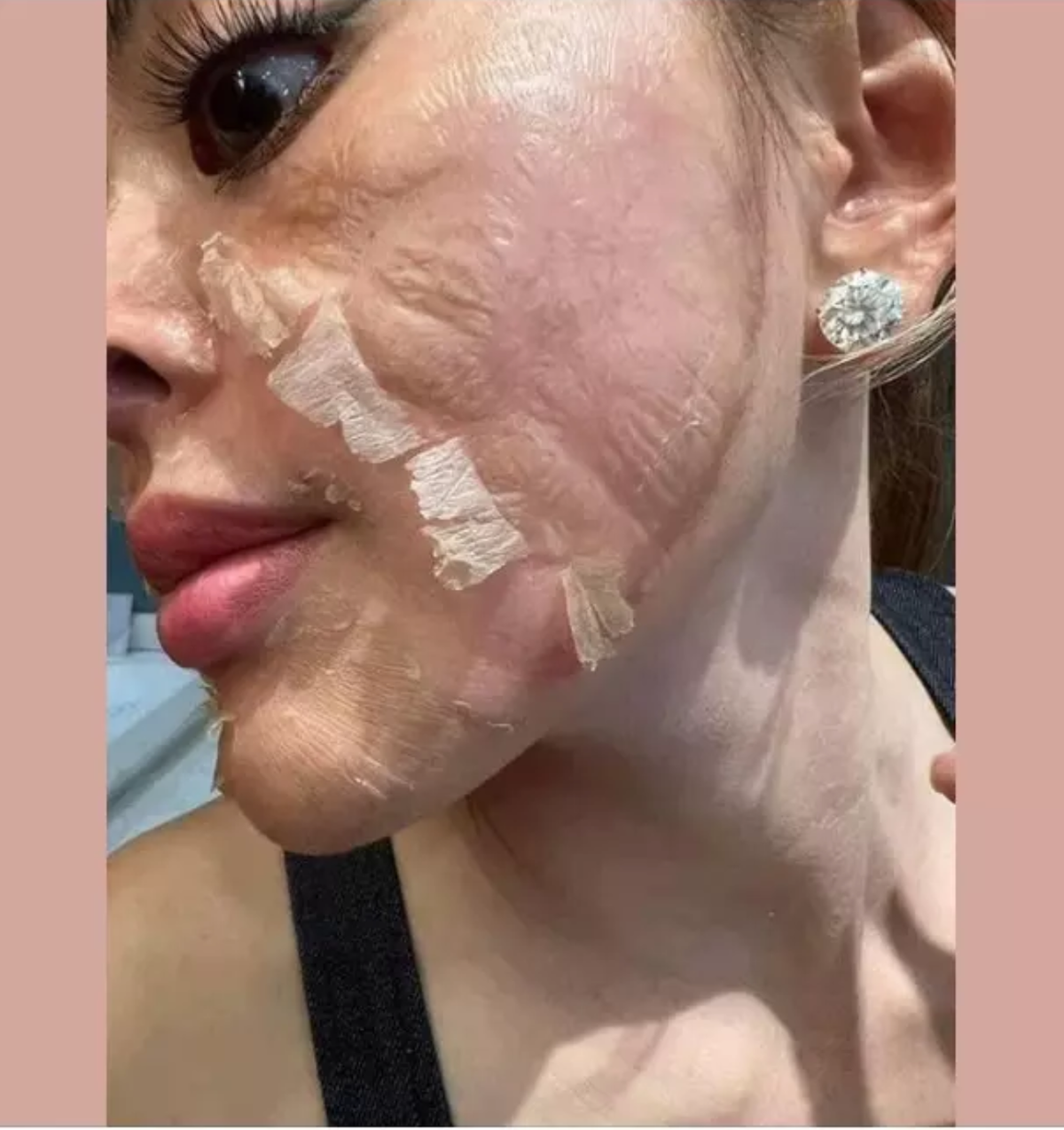 Cách đây không lâu Trang Nemo khiến netizen khiếp sợ khi chia sẻ hình ảnh làn da nhăn nheo, bị bóc vẩy từng mảng.