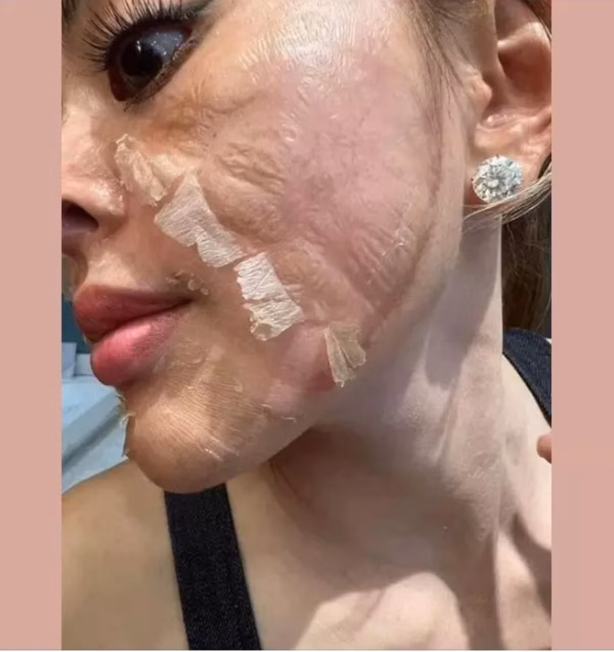 Cách đây không lâu Trang Nemo khiến netizen khiếp sợ khi chia sẻ hình ảnh làn da nhăn nheo, bị bóc vẩy từng mảng.