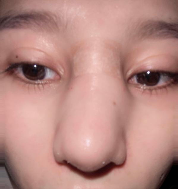 Cô cho biết sau khi thẩm mỹ tại một cơ sở, đẹp đâu chưa thấy đâu nhưng chiếc mũi của cô gặp phải biến chứng, ảnh hướng nghiêm trọng tới sức khỏe và công việc.