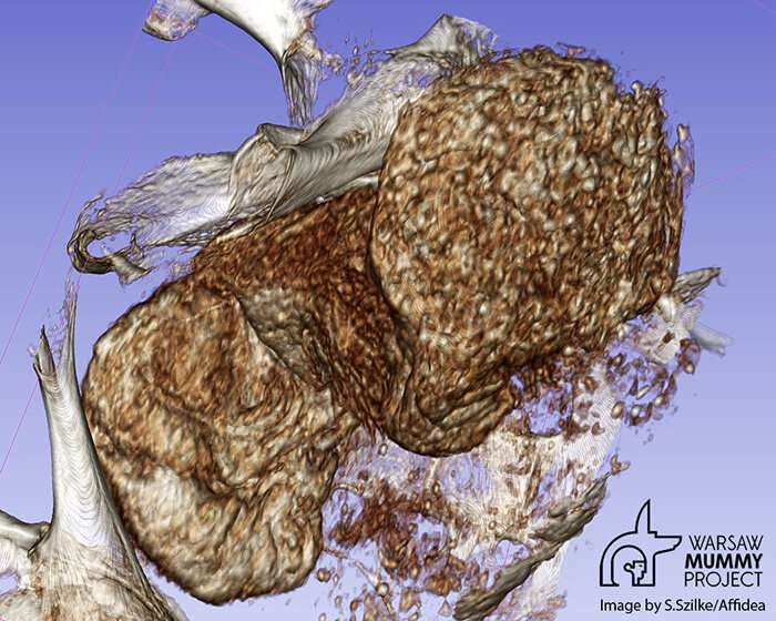 Sự thay đổi này sẽ dẫn đến các khoáng chất trong xương của thai nhi thoát ra, khiến xương khô đi và bị khoáng hóa.