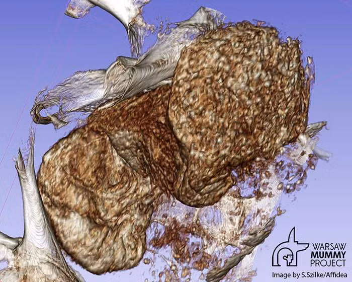 Sự thay đổi này sẽ dẫn đến các khoáng chất trong xương của thai nhi thoát ra, khiến xương khô đi và bị khoáng hóa.