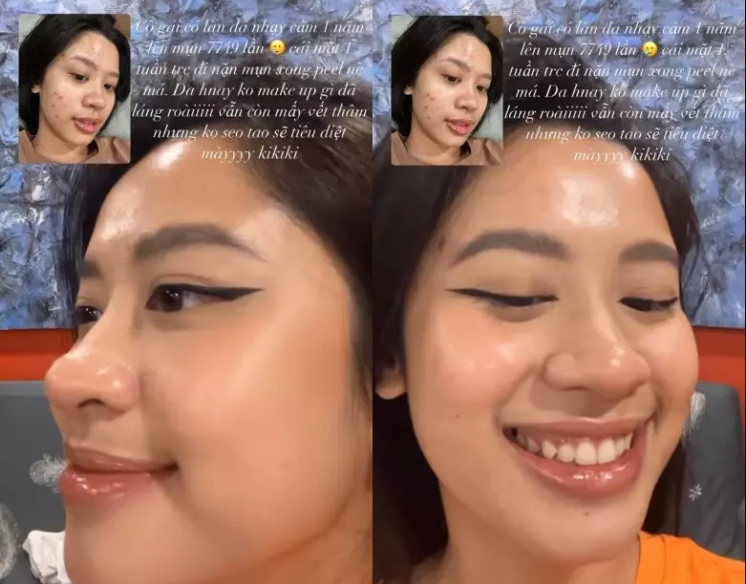 "Cô gái có làn da nhạy cảm. Một năm mụn lên 7749 lần. Cái mặt 1 tuần trước đi nặn mụn xong peel. Da hôm nay không make-up gì đã láng mịn lắm rồi, vẫn còn mấy vết thêm nhưng không sao sẽ tiêu diệt hết", Hàn Hằng chia sẻ.