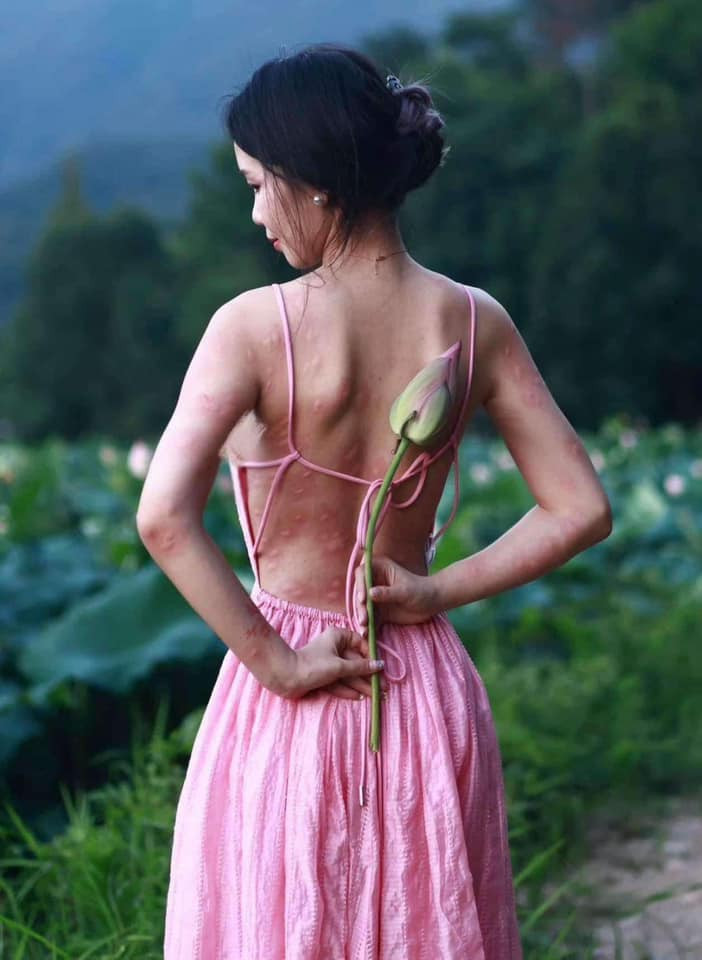 Tuy nhiên, khi một bức ảnh chưa được hậu kì đăng tải, nhiều người đã không khỏi bất ngờ. Bờ lưng trần của cô nàng chi chít những vết côn trùng đốt khiến người xem không khỏi xót xa.