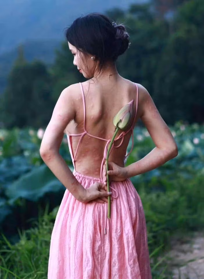 Tuy nhiên, khi một bức ảnh chưa được hậu kì đăng tải, nhiều người đã không khỏi bất ngờ. Bờ lưng trần của cô nàng chi chít những vết côn trùng đốt khiến người xem không khỏi xót xa.